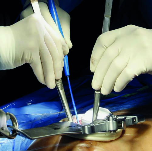 Curso Gratuito de Introducción a la Cirugía Valvular Mitral y Tricuspídea mediante Abordaje Mínimamente Invasivo (Tema de muestra-MFP en Cirugía Cardíaca MI)